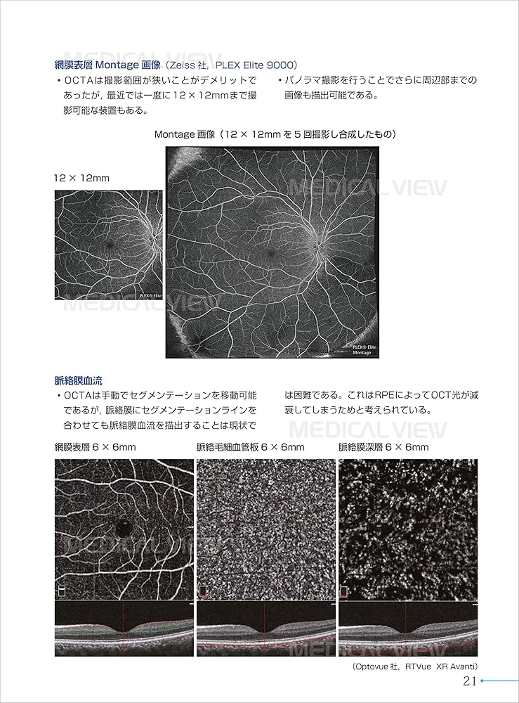 新OCT・OCTA読影トレーニング | 白神 史雄, 飯田 知弘 |本 | 通販 | Amazon